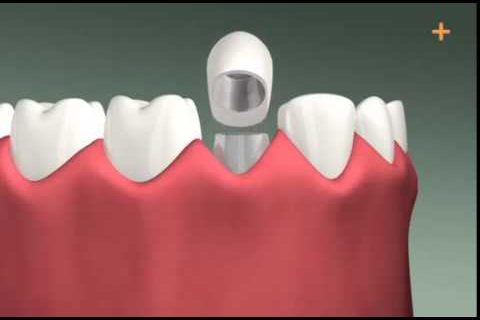 Mô phỏng quá trình cấp ghép răng