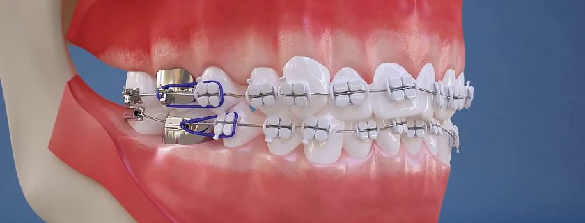 Quá trình phát triển răng và chỉnh nha